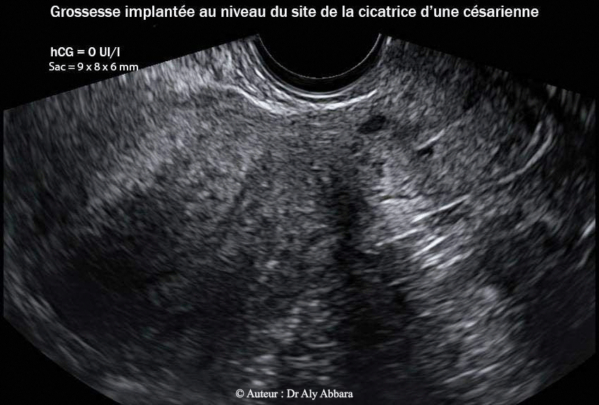 Grossesse ectopique intra-murale sur utérus cicatriciel -aspect de l'utérus 162 jours après le traitement par méthotrexate