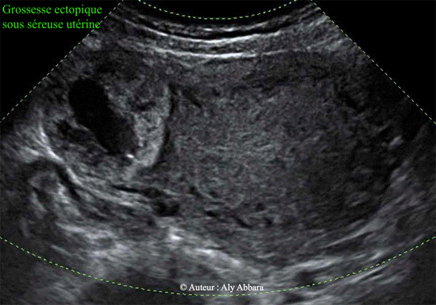 Grossesse extra-utérine sous-séreuse utérine - Images échographiques