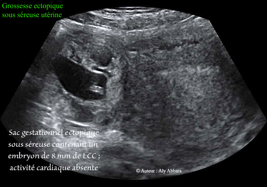 Grossesse extra-utérine sous-séreuse utérine - Images échographiques
