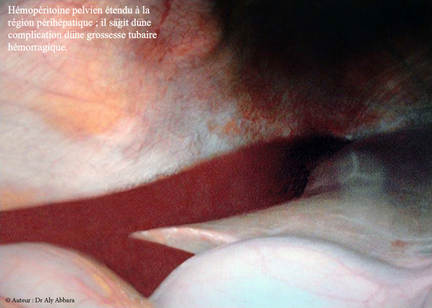 Hémopéritoine attéignant l'espace de Morrison 'espace interhépato-rénal) dans un contexte de grossesse ectopique tubaire hémorragique