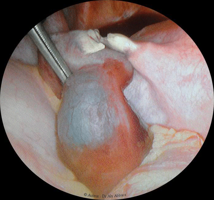 Grossesse ectopique tubaire post-stérilisation tubaire per-coelioscopie