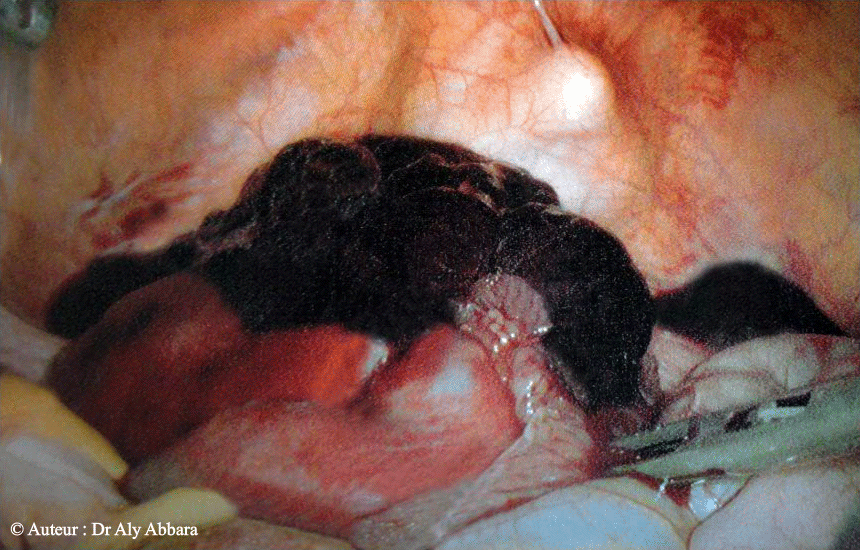 Avortement tubo-abdominal - Images cliniques coelioscopique