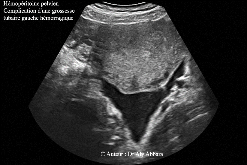 Hémopéritoine pelvien dû à une grossesse ectopique tubaire hémorragique