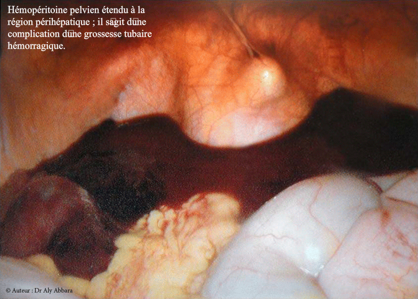 Hémopéritoine pelvien dû à une grossesse ectopique tubaire hémorragique -Images cliniques coelioscopiques