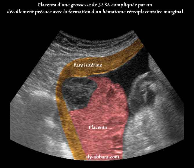 Hématome rétroplacentaire décidual basal et latéral du placenta à ...