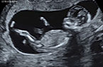 Foetus de 13 SA - mouvements actifs de type rebondissements