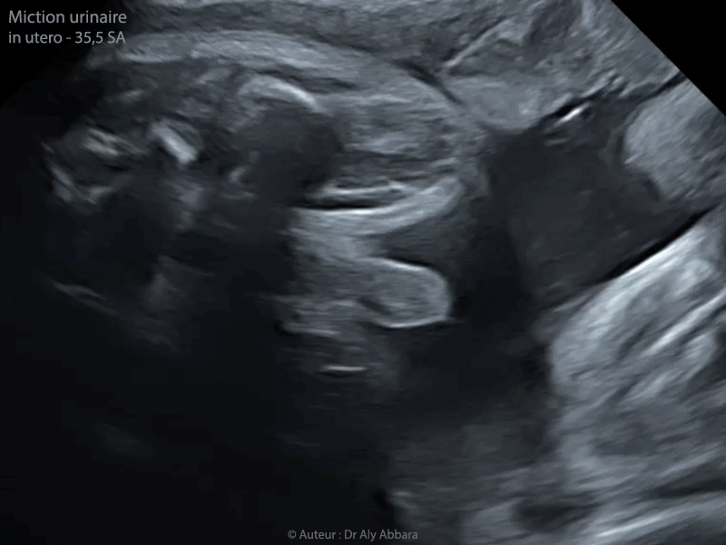 Miction urinaire chez un foetus de 35,5 SA