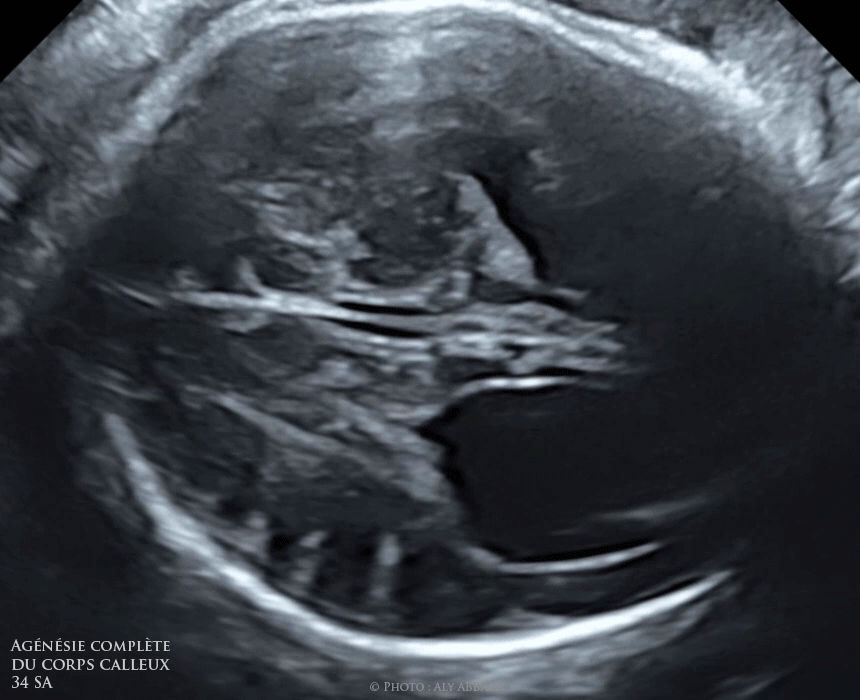 Agénésie complète du corps calleux Le signe de triple feuillet Agénésie complète du corps calleux Le signe de triple feuillet