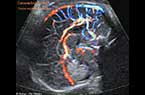 Coupe sagittale médiane du cerveau fœtale - vaisseaux sanguins et les structures anatomiques à 33 SA - échocardiographie