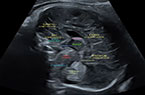 Coupe sagittale médiane du cerveau fœtal (à 35 SA) - éléments anatomiques identifiables en échographie