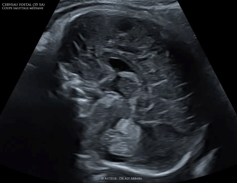 Coupe sagittale médiane du cerveau fœtal (à 35 SA) - Eléments anatomiques identifiables en échographie