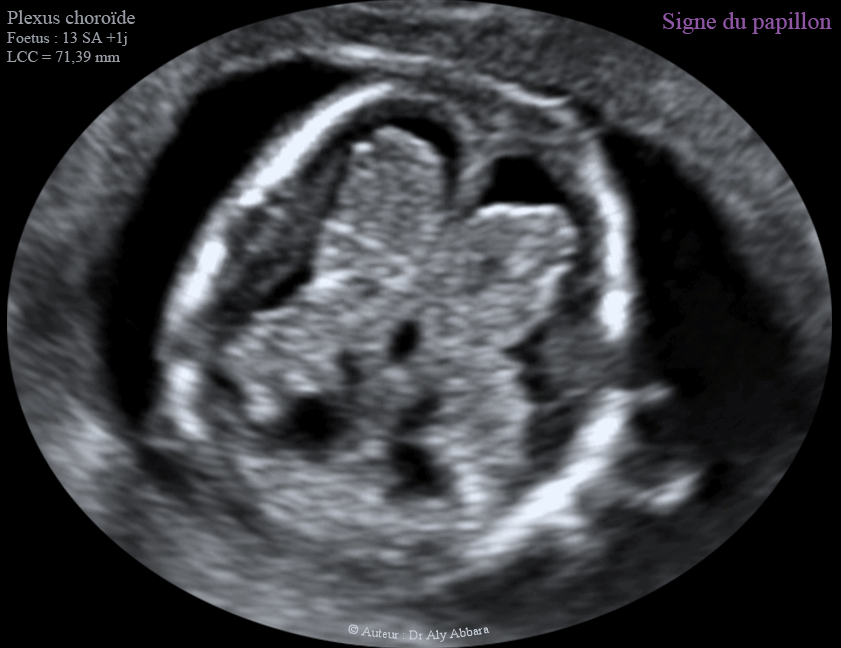 Les deux plexus choroïdes et le signe du papillon - 12 - 13 SA - الضفائر المشيمية في الدماغ وعلامة الفراشة