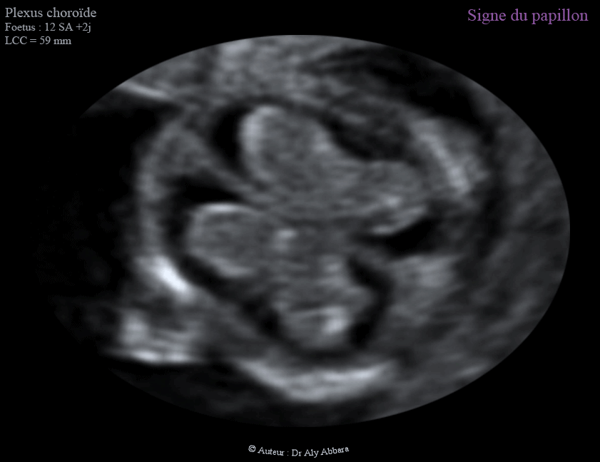 Les plexus choroïdes et le signe du papillon - 12 - 13 SA - الضفائر المشيمية في الدماغ وعلامة الفراشة