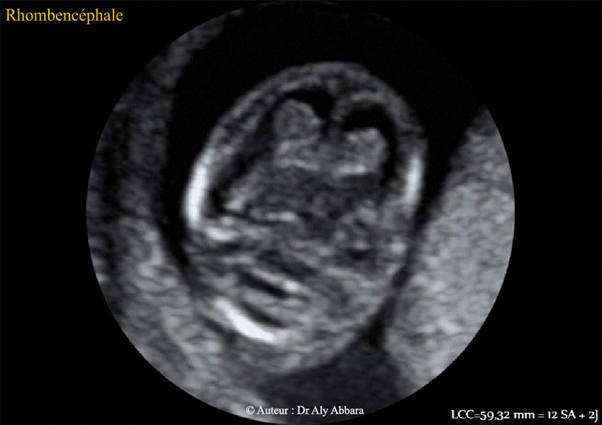 Cerveau foetal à 12 SA + 2J - Rhombencéphale et fosse postérieure - Echographie