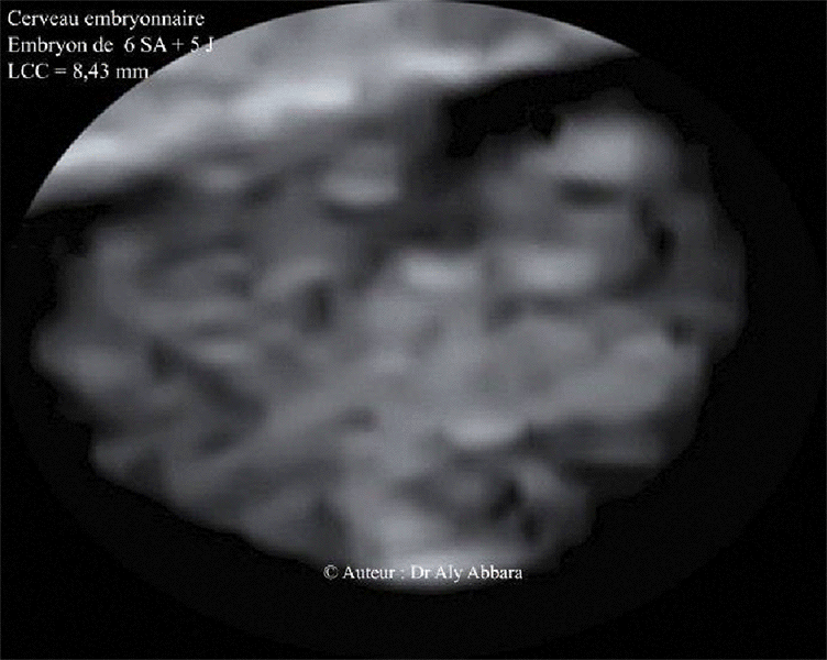 Embryon de 6SA et 5J - Structures cérébrales identifiables à l'échographie