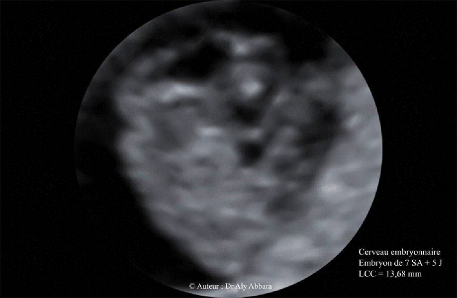Cerveau embryonnaire à 7 SA et 5 jours - Strucutres identifiables en échographie