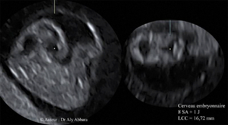 Cerveau embryonnaire à 8SA et 1J - structures cérébrales identifiables en échographie