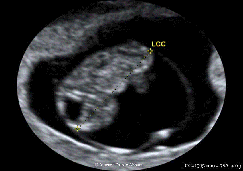 Fosse-rhombencéphalique - développement entre 7SA et 9SA- Echographie
