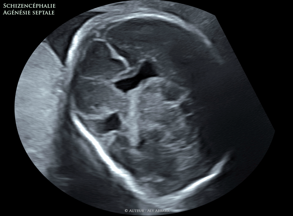 Schizencéphalie et agénésie septale - foetus de 28 SA