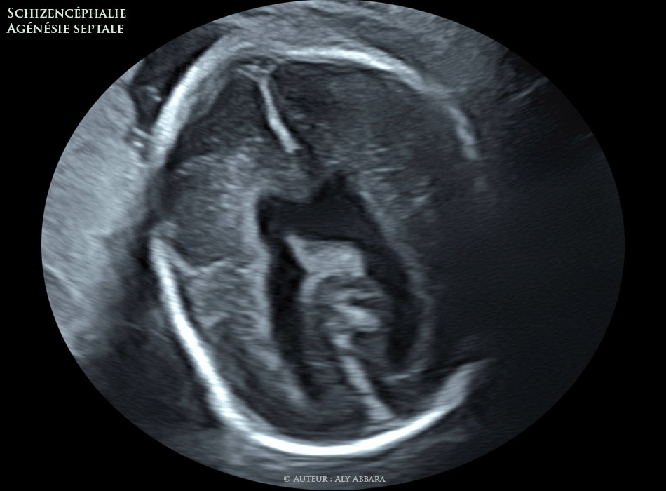 Schizencéphalie et agénésie septale - foetus de 28 SA