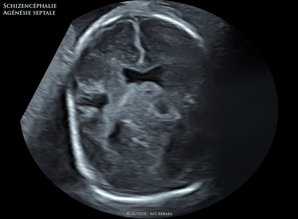 Schizencéphalie et agénésie septale - foetus de 28 SA