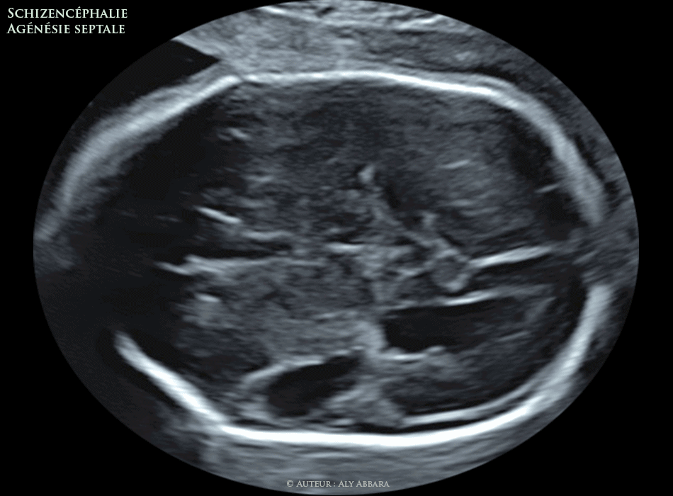 Kyste splénique - grossesse de 31 SA