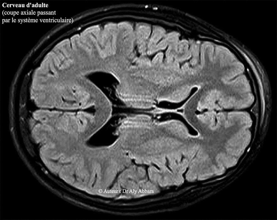 Cerveau d'adulte - IRM - Coupe axiale - ventricules