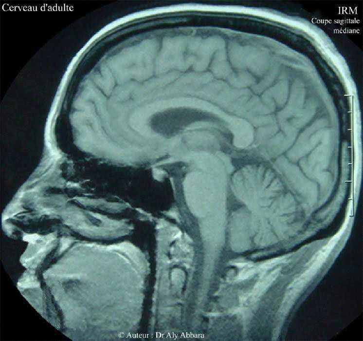 Série animée de coupes sagittales en IRM (AAHscout) montrant l'ensemble du cerveau normal chez une femme âgée de 26 ans