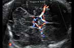 Polygone vasculaire de Willis - composition - cerveau foetal à 29 SA - échocardiographie