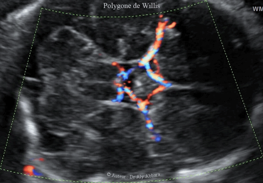Coupe sagittale médiane du cerveau foetale - vaisseaux sanguins et les structures anatomiques identifiable à 33 SA - échocardiographie