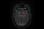Cerveau de femme adulte - Réseau vasculaire artériel - Principales artères cérébrales et leurs parcours