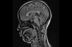 Cerveau humain - femme de 26 ans - balayage sgittal par IRM