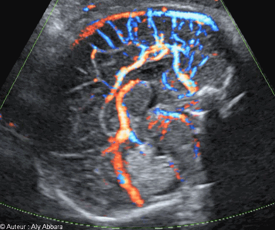 Coupe sagittale médiane du cerveau foetale - vaisseaux sanguins et les structures anatomiques identifiable à 33 SA - échocardiographie