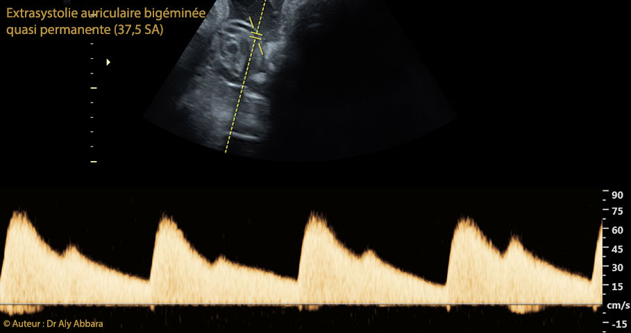 Kyste cytotrophoblastique intra-parenchymateux