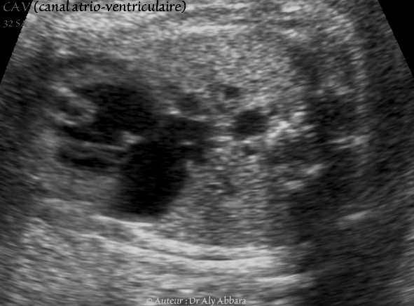 Canal atrio-ventriculaire complet - CAV - 32 SA - Vidéo et image animée échocardiographiques - القناة الأذينية البطينية