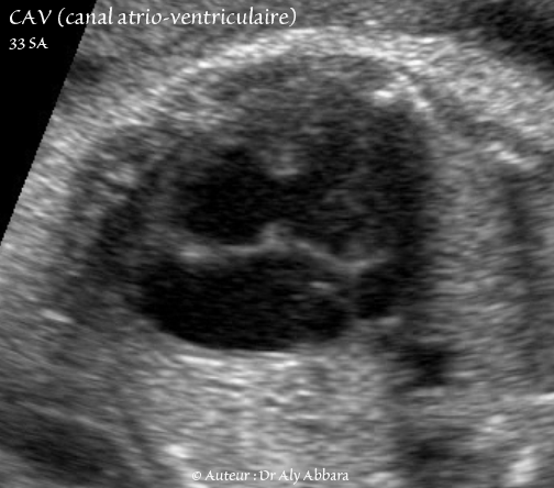 Canal atrio-ventriculaire complet - CAV - 33 SA - Vidéo et image animée échocardiographiques - القناة الأذينية البطينية - GIF animée 