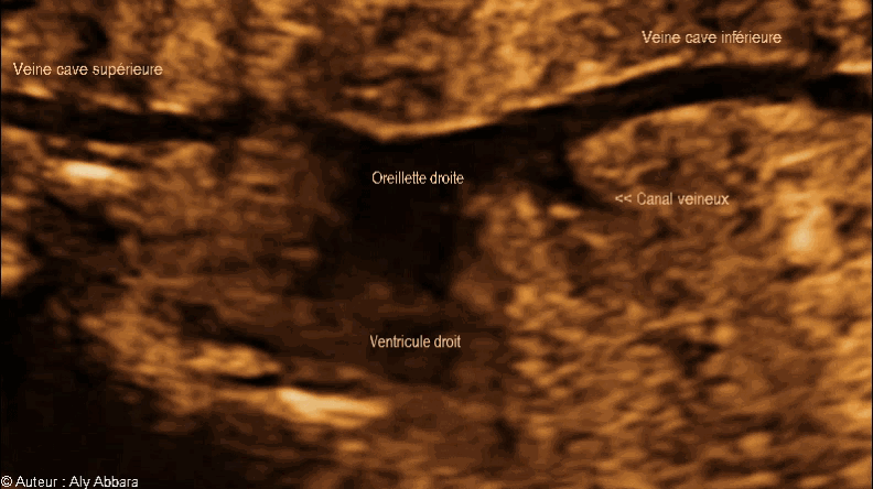 Les deux veines caves, supérieure et inférieure se jetant dans l'oreillette droite - الوريدان الأجوفان، العلوي والسفلي يصبان في الأذينة اليمنى للقلب