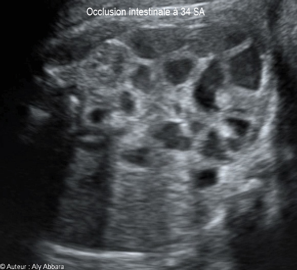 Occlusion intestinale caractérisée par la dilatation des anses grêles et une hyperpéristaltisme : foetus de 34 SA