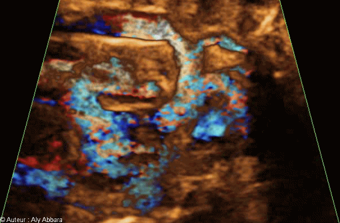 Crosse de l'aorte caractérisée par l'absence de l'artère subclavière gauche : foetus de 34 SA - قوس ابهرية متميزة بغياب فرعها الرئيسي الثالث أي الشريان ماتحت الترقوي الأيسر