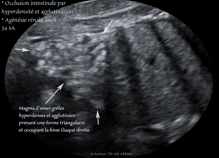 Magma d'anses grêles hyperdenses, agglutinées et obstructives : foetus de 34 SA