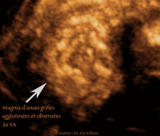 Magma d'anses grêles hyperdenses, agglutinées et obstructives : foetus de 34 SA