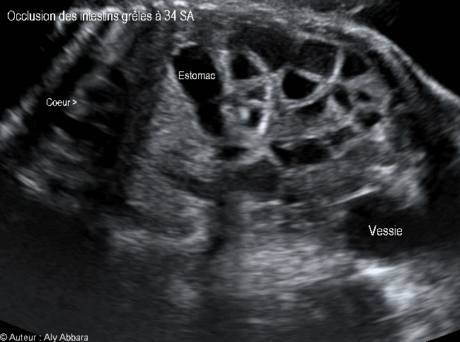 Occlusion intestinale caractérisée par la dilatation des anses grêles et une hyperpéristaltisme : foetus de 34 SA