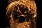 Coupe classique des 4 cavités cardiaques - foetus de 36 SA