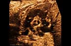 Coupe de petit axe (coeur droit) - foetus de 36 SA