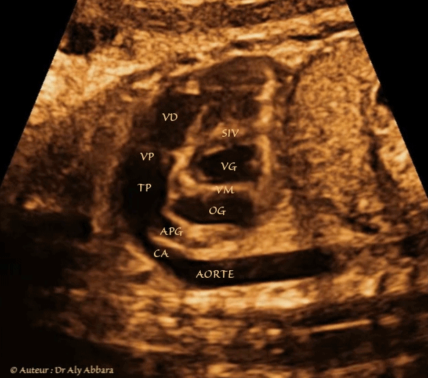 Coeur droit - coupe de petit axe  - éléments anatomiques - foetus de 36 SA
