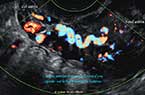 La portion terminale de l'artère utérine prenant la forme d'une spirale sur le bord latéral de l'utérus (ici : côté gauche) - Utérus non gravide