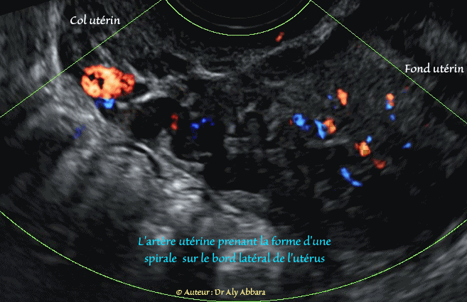 La portion terminale de l'artère utérine prenant la forme d'une spirale sur le bord latéral de l'utérus (ici : côté gauche)