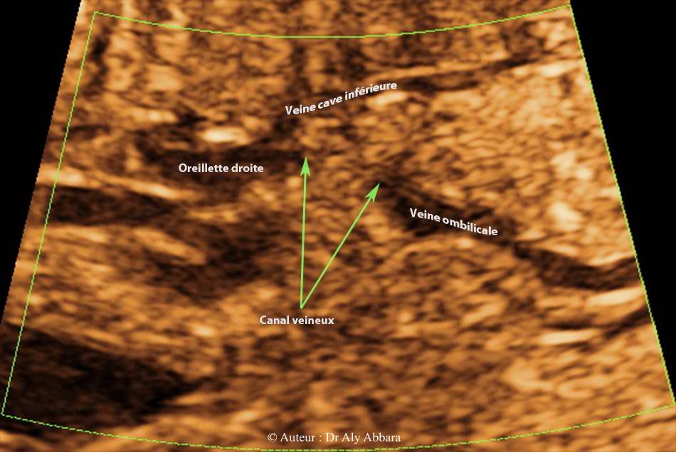 la terminaison du canal veineux à la partie terminale de la veine cave inférieure - image 1
