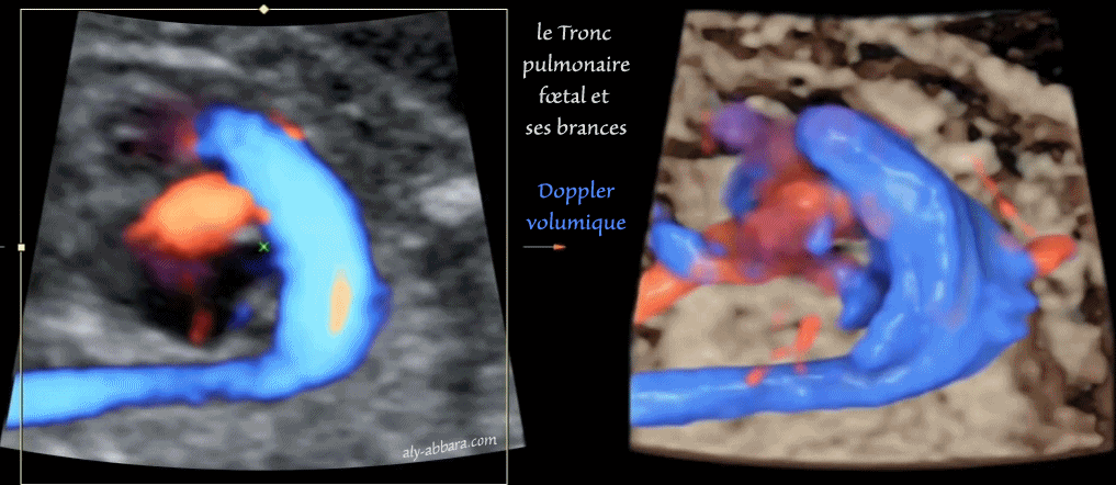 Artère ombilicale unique - grossesse de 33 SA - Absence de d'anomalie associée