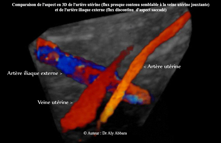 Doppler couleur de l'artère utérine (spectre continu) et l'artère ilique externe (spectre saccadé)